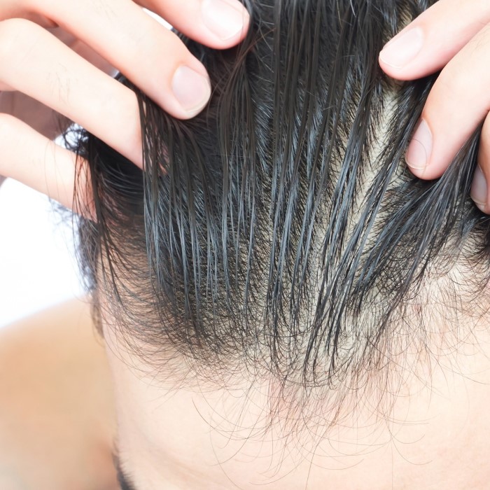 accutane hair loss before and after