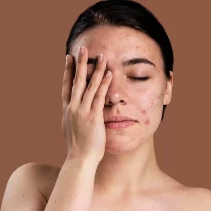 accutane hair loss before and after